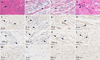 Frontiers | Neutrophil infiltration and myocarditis in patients